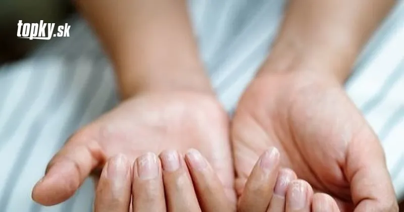 Profesor odhalil netypický príznak nákazy KORONAVÍRUSOM: Pozor na covid nechty! | Topky.sk