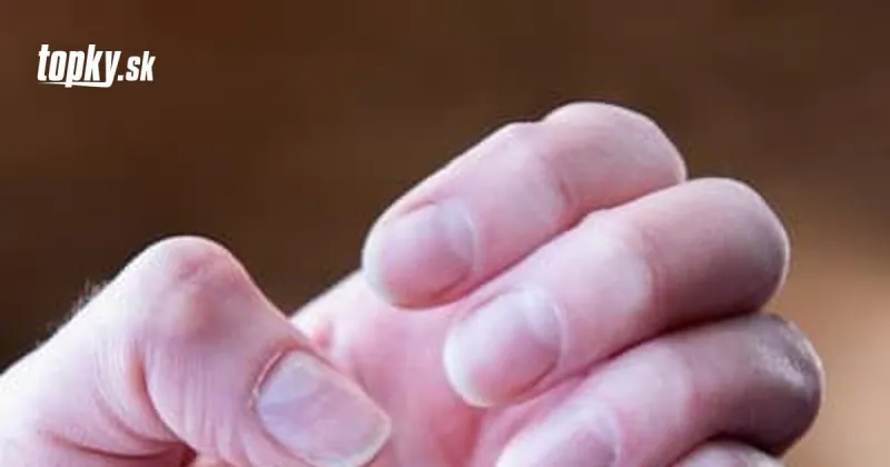 Nakazili ste sa? Tieto zmeny na nechtoch prezradia, či máte KORONAVÍRUS! | Topky.sk