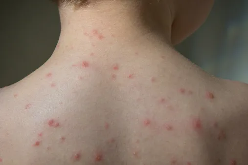 Od začiatku epidémie osýpok nemocnica v Michalovciach hospitalizovala takmer 300 pacientov | Topky.sk