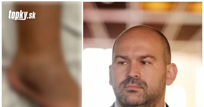 Nešťastný začiatok leta u podpredsedu parlamentu: Pčolinského najbližší skončil s obviazanou nohou! | Topky.sk